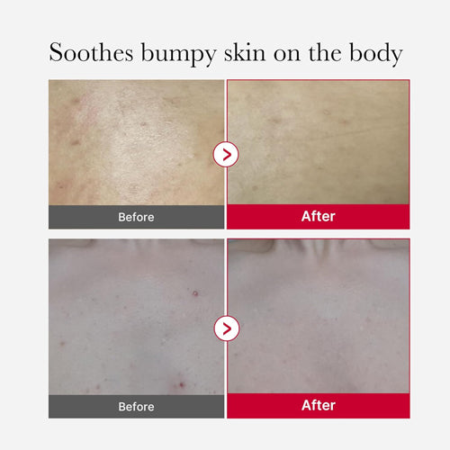 MEDICUBE Red Acne Body Peeling Shot 2.0 110g — product image 4